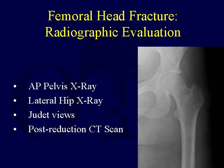 Femoral Head Fracture: Radiographic Evaluation • • AP Pelvis X-Ray Lateral Hip X-Ray Judet