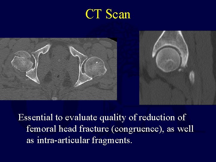 CT Scan Essential to evaluate quality of reduction of femoral head fracture (congruence), as
