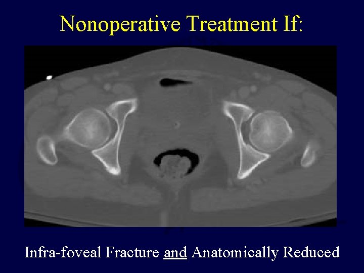 Nonoperative Treatment If: Infra-foveal Fracture and Anatomically Reduced 