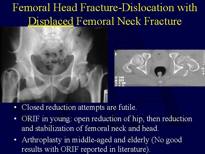 Femoral Head Fracture-Dislocation with Displaced Femoral Neck Fracture • Closed reduction attempts are futile.