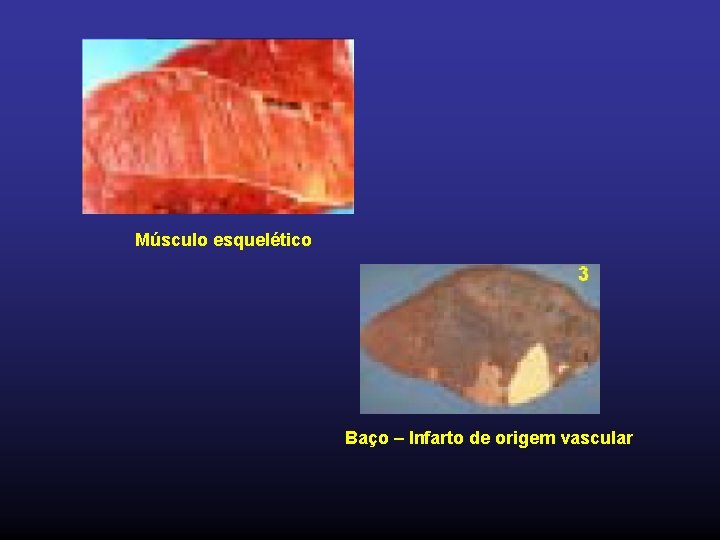 Músculo esquelético Baço – Infarto de origem vascular 