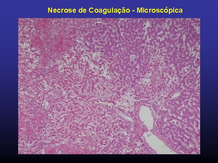 Necrose de Coagulação - Microscópica 