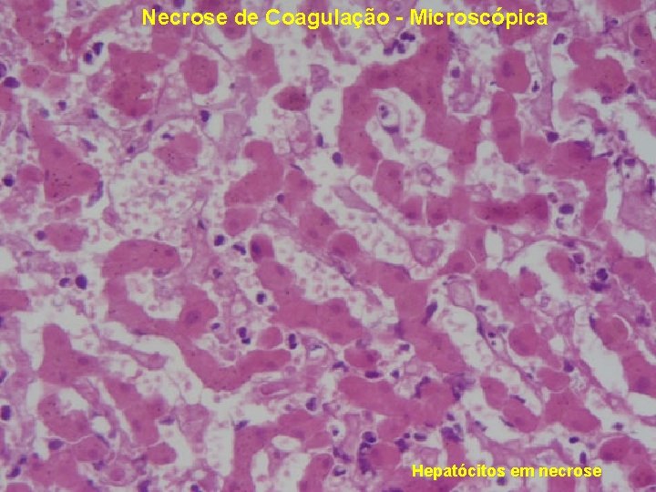 Necrose de Coagulação - Microscópica Hepatócitos em necrose 