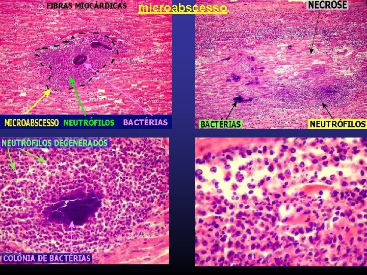 microabscesso. 