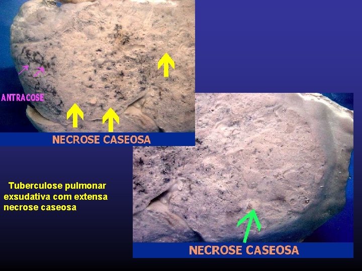  Tuberculose pulmonar exsudativa com extensa necrose caseosa 