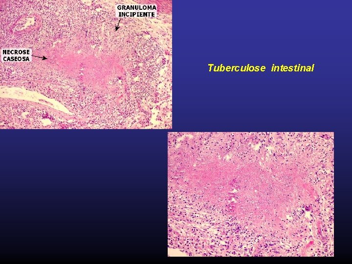 Tuberculose intestinal 