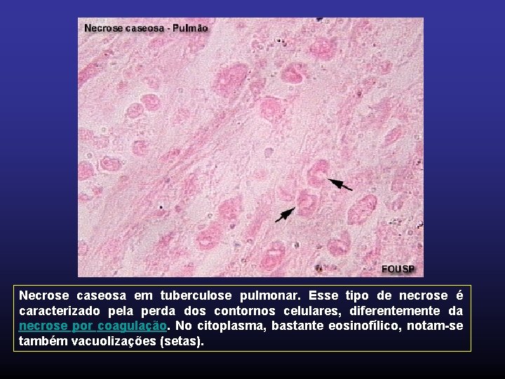 Necrose caseosa em tuberculose pulmonar. Esse tipo de necrose é caracterizado pela perda dos