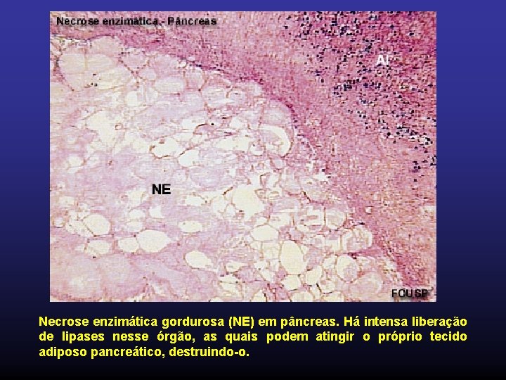 Necrose enzimática gordurosa (NE) em pâncreas. Há intensa liberação de lipases nesse órgão, as