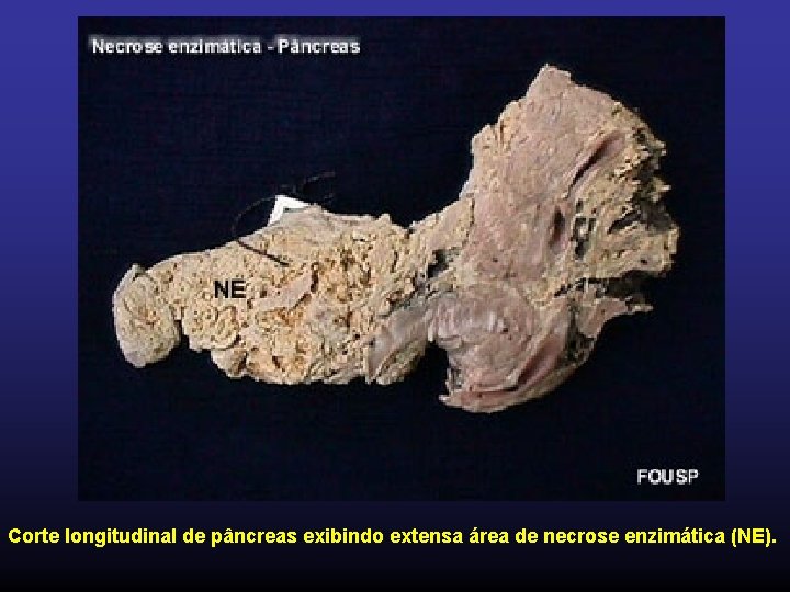 Corte longitudinal de pâncreas exibindo extensa área de necrose enzimática (NE). 