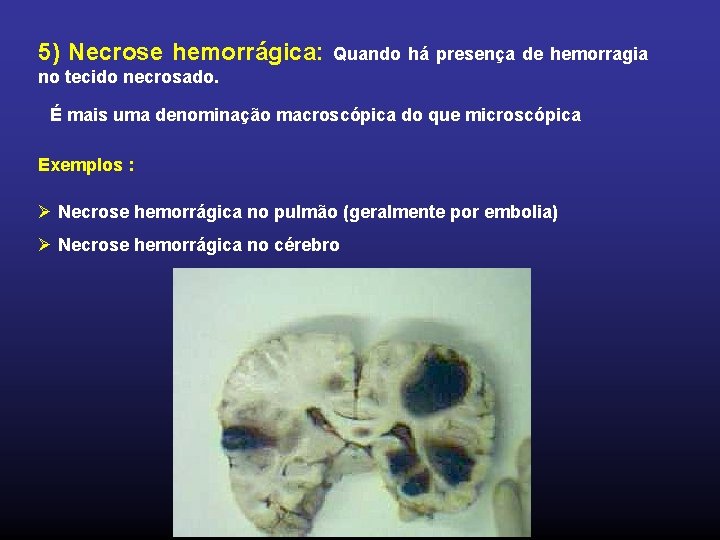 5) Necrose hemorrágica: Quando há presença de hemorragia no tecido necrosado. É mais uma