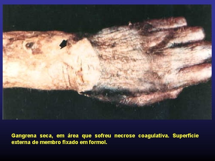 Gangrena seca, em área que sofreu necrose coagulativa. Superfície externa de membro fixado em