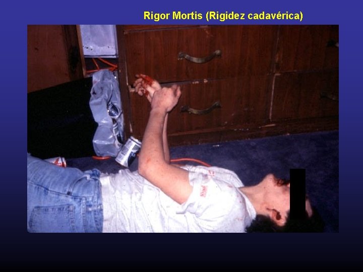 Rigor Mortis (Rigidez cadavérica) 