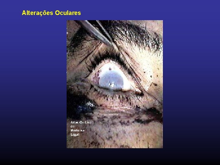 Alterações Oculares 