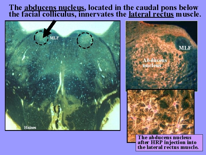 The abducens nucleus, located in the caudal pons below the facial colliculus, innervates the