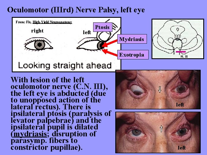 Oculomotor (IIIrd) Nerve Palsy, left eye From: Fix, High-Yield Neuroanatomy right left Ptosis Mydriasis