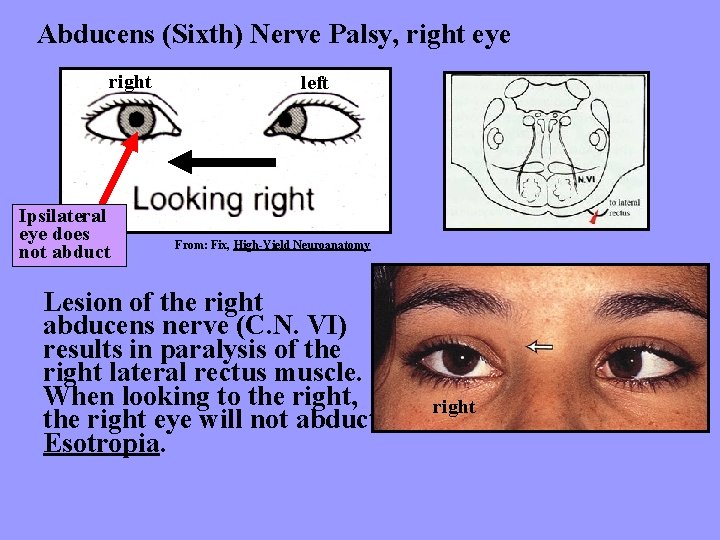 Abducens (Sixth) Nerve Palsy, right eye right Ipsilateral eye does not abduct left From: