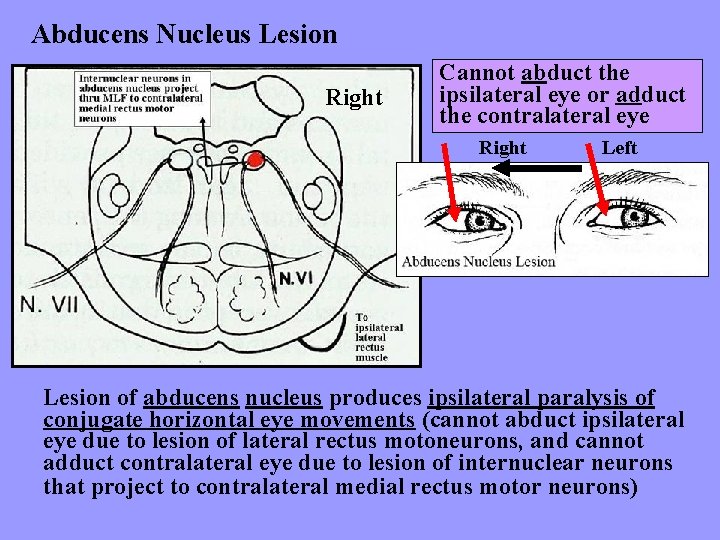 Abducens Nucleus Lesion Right Cannot abduct the ipsilateral eye or adduct the contralateral eye