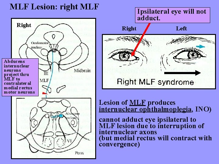 MLF Lesion: right MLF Right Ipsilateral eye will not adduct. Right Left Abducens internuclear