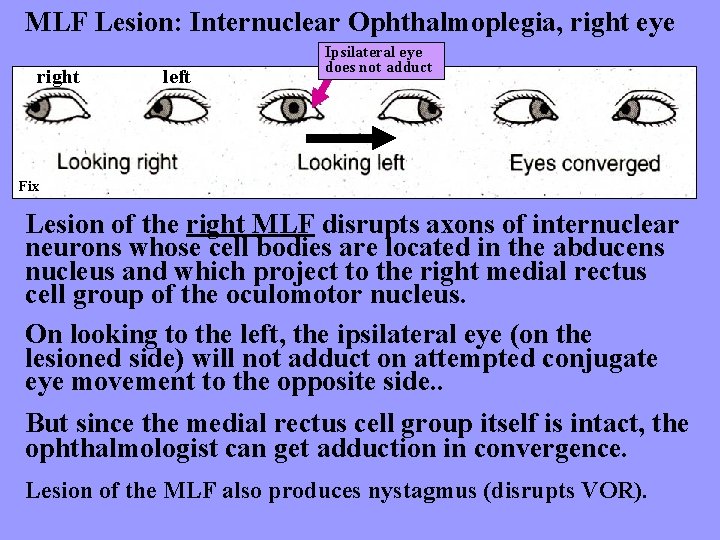 MLF Lesion: Internuclear Ophthalmoplegia, right eye right left Ipsilateral eye does not adduct Fix