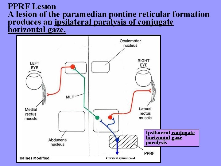 PPRF Lesion A lesion of the paramedian pontine reticular formation produces an ipsilateral paralysis