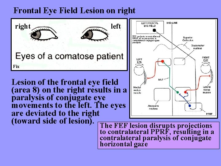 Frontal Eye Field Lesion on right left Fix Lesion of the frontal eye field