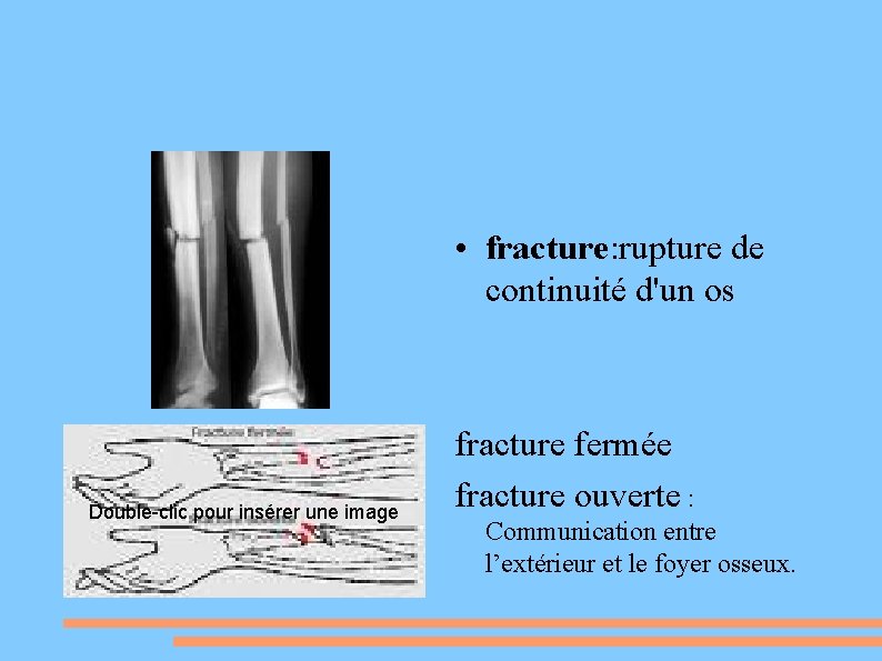  • fracture: rupture de continuité d'un os Double-clic pour insérer une image fracture