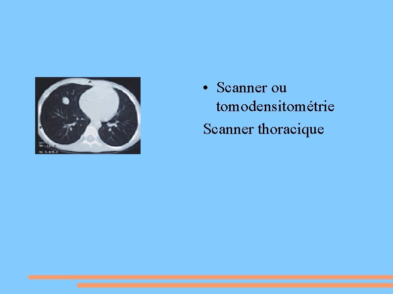  • Scanner ou tomodensitométrie Scanner thoracique 