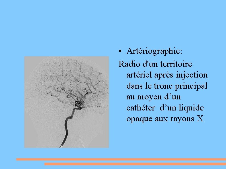  • Artériographie: Radio d'un territoire artériel après injection dans le tronc principal au
