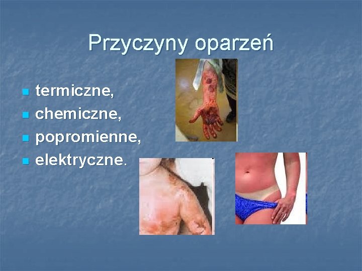 Przyczyny oparzeń n n termiczne, chemiczne, popromienne, elektryczne. 