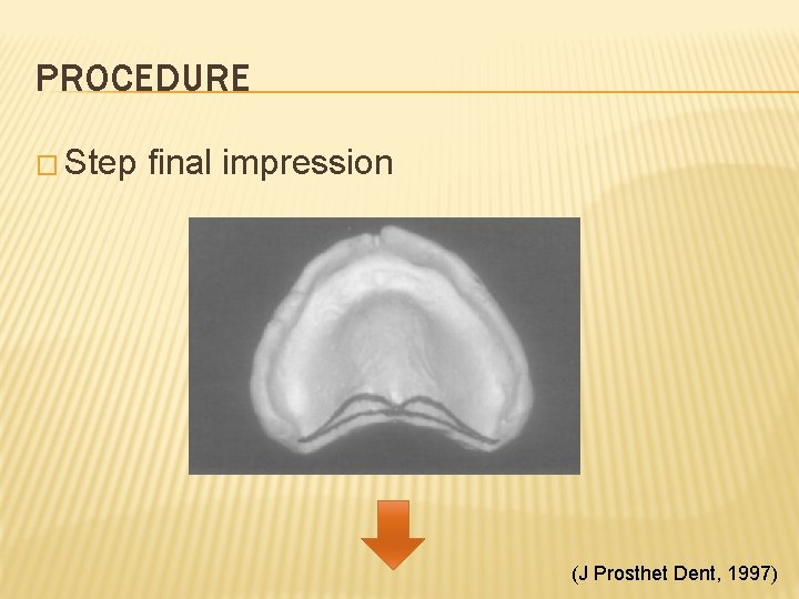 PROCEDURE � Step final impression (J Prosthet Dent, 1997) 