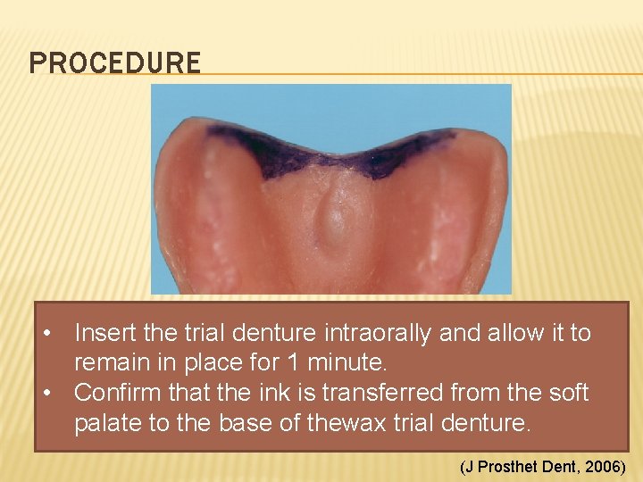 PROCEDURE • Insert the trial denture intraorally and allow it to remain in place