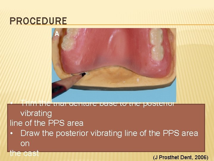 PROCEDURE • Trim the trial denture base to the posterior vibrating line of the