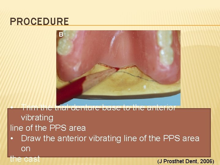 PROCEDURE • Trim the trial denture base to the anterior vibrating line of the