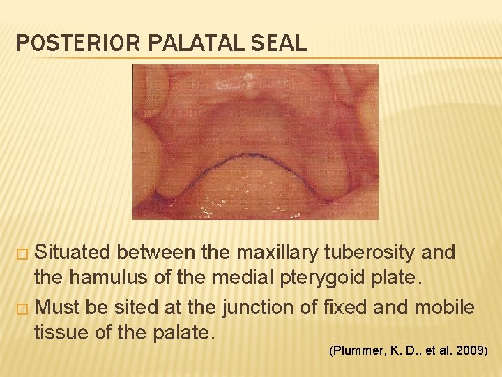 POSTERIOR PALATAL SEAL � Situated between the maxillary tuberosity and the hamulus of the