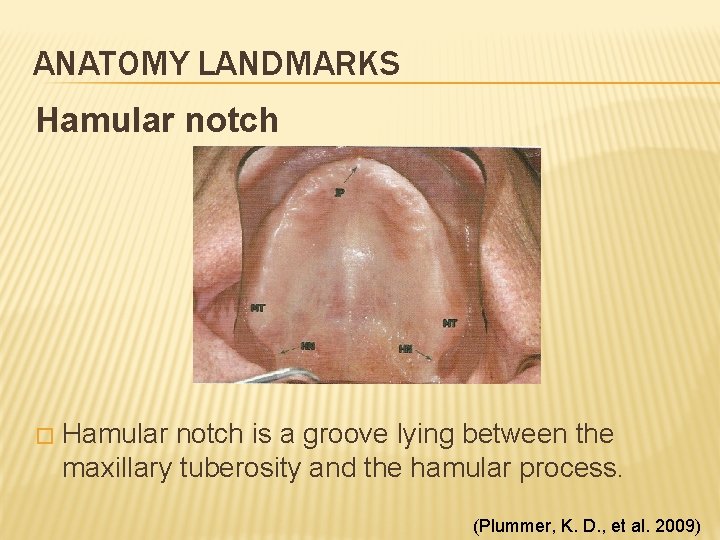 ANATOMY LANDMARKS Hamular notch � Hamular notch is a groove lying between the maxillary