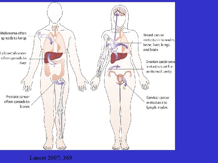 Lancet 2007; 369 