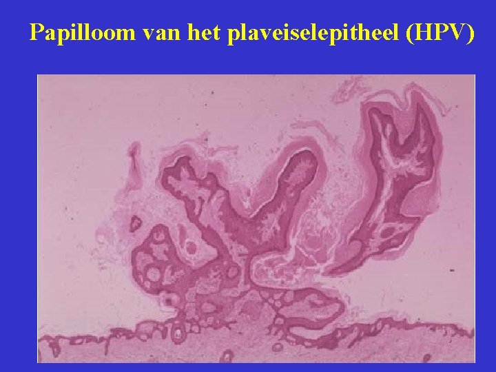 Papilloom van het plaveiselepitheel (HPV) 