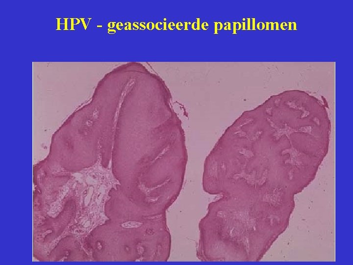 HPV - geassocieerde papillomen 