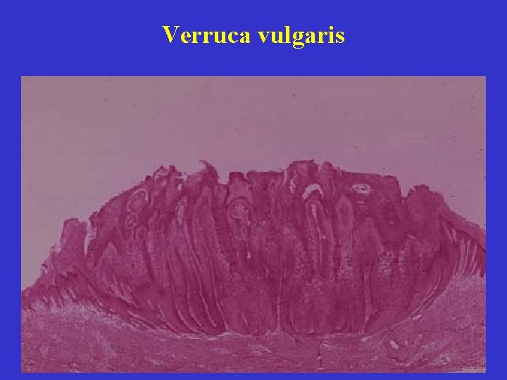 Verruca vulgaris 