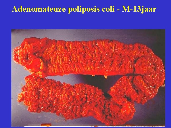 Adenomateuze poliposis coli - M-13 jaar 