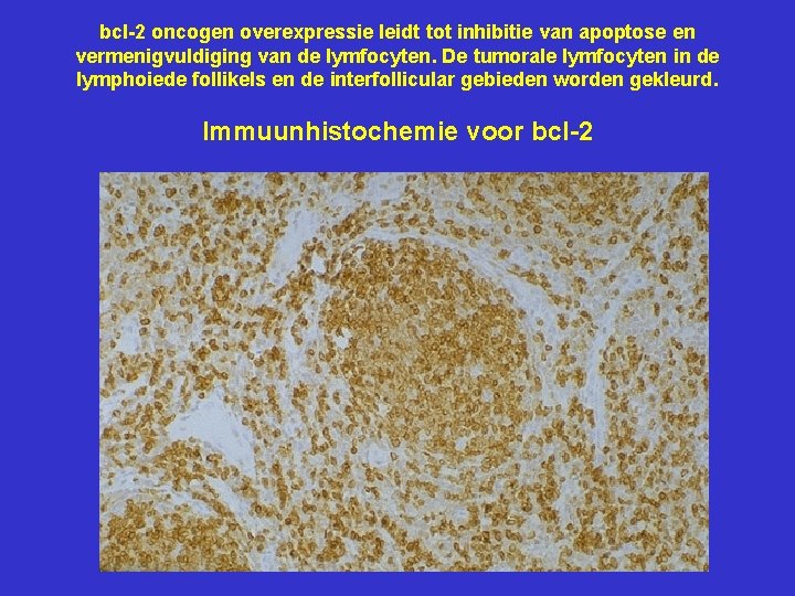 bcl-2 oncogen overexpressie leidt tot inhibitie van apoptose en vermenigvuldiging van de lymfocyten. De