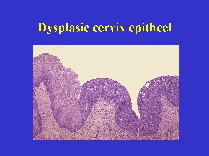 Dysplasie cervix epitheel 