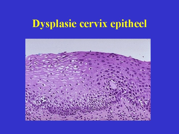 Dysplasie cervix epitheel 