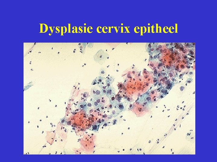 Dysplasie cervix epitheel 