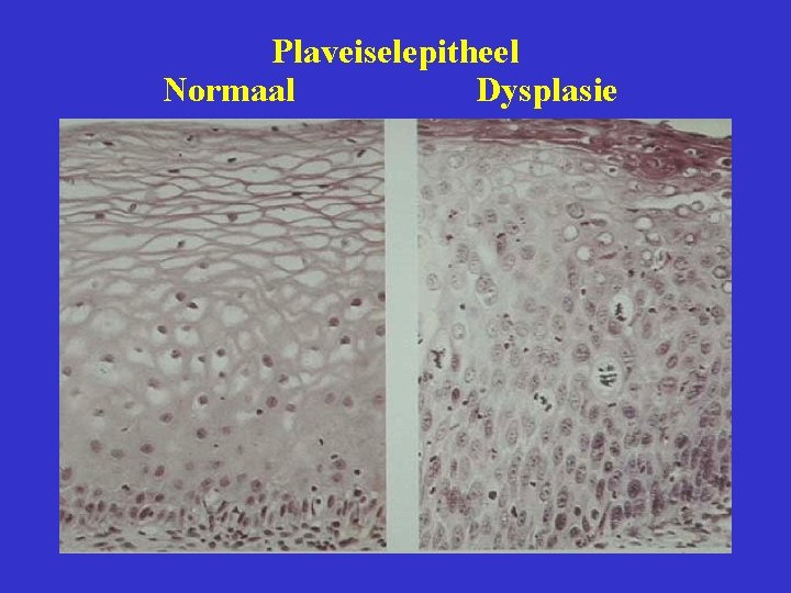 Plaveiselepitheel Normaal Dysplasie 