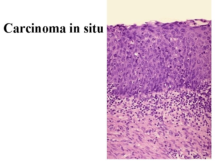 Carcinoma in situ 