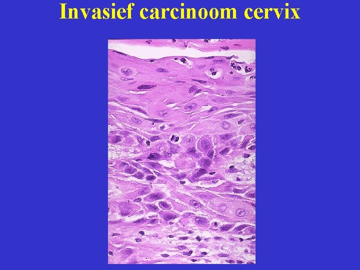 Invasief carcinoom cervix 