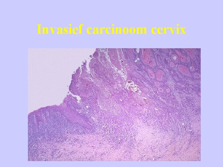 Invasief carcinoom cervix 