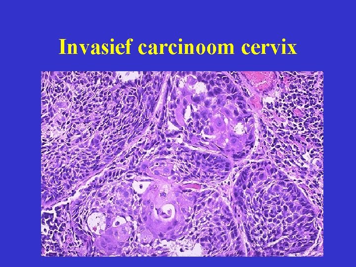 Invasief carcinoom cervix 