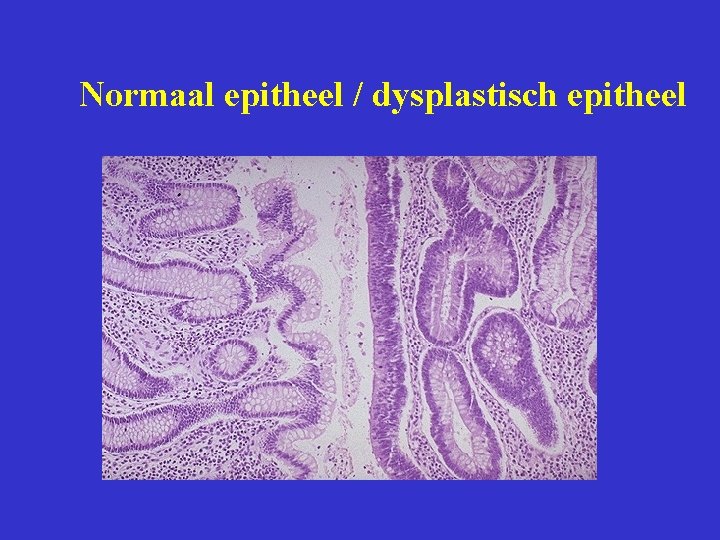 Normaal epitheel / dysplastisch epitheel 